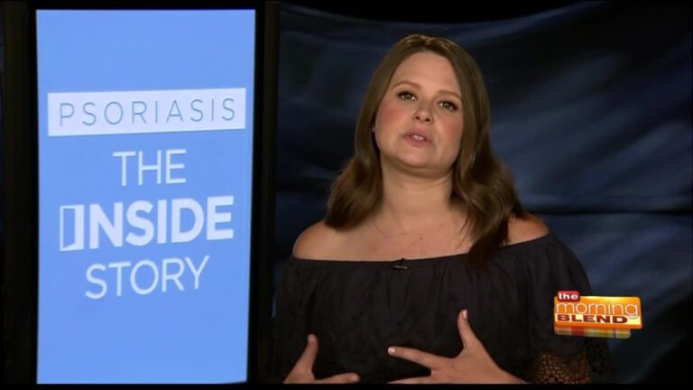 ABC’s Scandal’s Katie Lowes talks living with Psoriasis